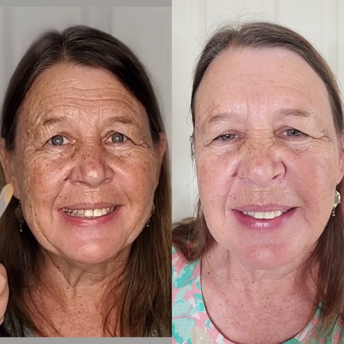 Before and after Wrinkles